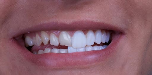 Prix des facettes dentaires - Tout ce que vous devez savoir - Top