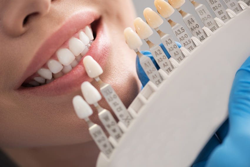 Couronne Dentaire Turquie: Prix & Procédure - MeilleureClinique