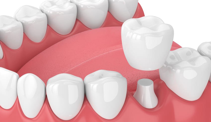 Facette Dentaire : Le Guide Complet Par Dr. Zisserman