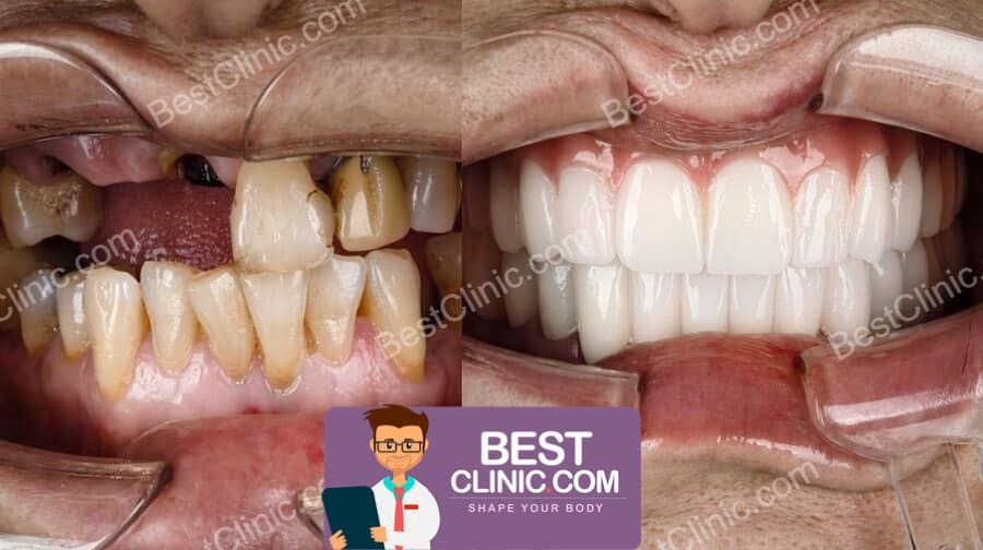 Couronne Dentaire Turquie: Prix & Procédure - MeilleureClinique